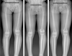 ΑΝΙΣΟΣΚΕΛΙΑ