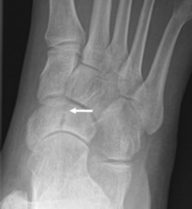 katagma-koposis-e-podi-picture-03