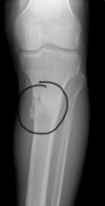 katagma-koposis-e-podi-picture-04