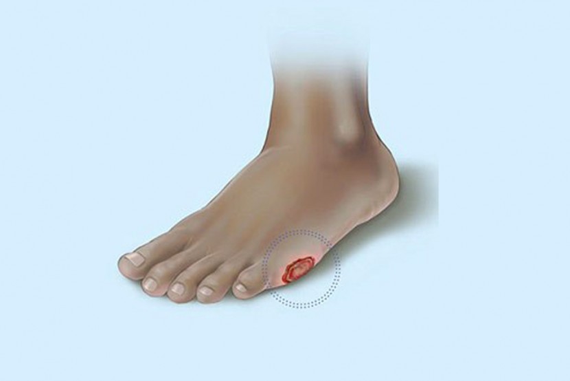 ΤΟ ΔΙΑΒΗΤΙΚΟ ΠΟΔΙ