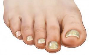 aitia-allagon-sto-derma-kai-sta-nyxia-e-podi-picture-01