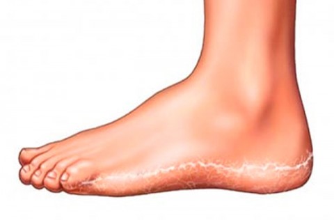 ΠΩΣ ΘΑ ΑΠΟΦΥΓΕΤΕ ΤΟ “ΠΟΔΙ ΤΟΥ ΑΘΛΗΤΗ”