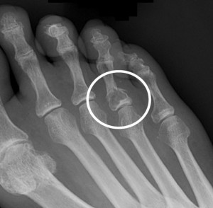 katagma-daxtylou-e-podi-picture-01