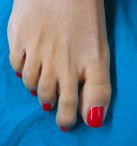 mortons-toe-e-podi-picture-02