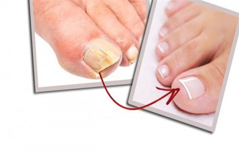 ΟΝΥΧΟΜΥΚΗΤΙΑΣΗ