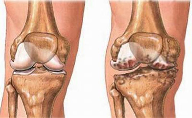 osteoarthritida-e-podi-picture-03