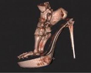 osteoarthritida-e-podi-picture-04