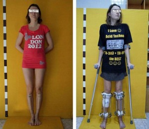 xeirourgio-gia-liga-ekatosta-ypsous-e-podi-picture-02