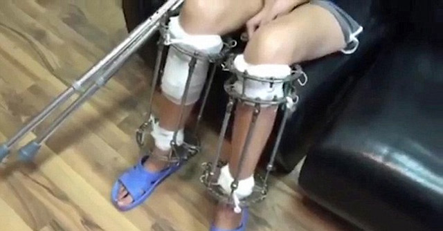 xeirourgio-gia-liga-ekatosta-ypsous-e-podi-picture-03