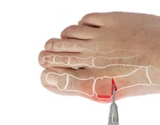 ΔΙΑΔΕΡΜΙΚΗ, ΕΛΑΧΙΣΤΑ ΠΑΡΕΜΒΑΤΙΚΗ ΜΙΚΡΟΧΕΙΡΟΥΡΓΙΚΗ ΜΕΘΟΔΟΣ – ΜIS