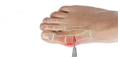 ΔΙΑΔΕΡΜΙΚΗ, ΕΛΑΧΙΣΤΑ ΠΑΡΕΜΒΑΤΙΚΗ ΜΙΚΡΟΧΕΙΡΟΥΡΓΙΚΗ ΜΕΘΟΔΟΣ – ΜIS
