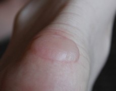 ΦΟΥΣΚΑΛΕΣ ΣΤΑ ΠΟΔΙΑ ΤΩΝ ΑΘΛΗΤΩΝ