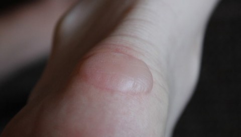 ΦΟΥΣΚΑΛΕΣ ΣΤΑ ΠΟΔΙΑ ΤΩΝ ΑΘΛΗΤΩΝ