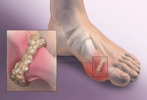 ΟΥΡΙΚΗ ΑΡΘΡΙΤΙΔΑ – ΠΟΔΑΓΡΑ