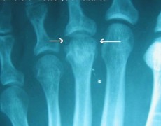 Νόσος του Freiberg