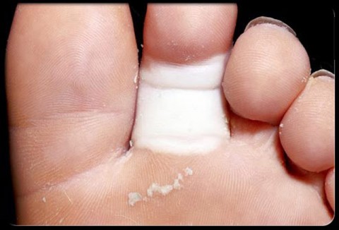 Φαινόμενο Raynaud