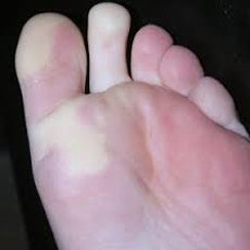 raynaud’s-phenomenon-e-podi-picture-02