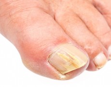 Μυκητίαση νυχιών