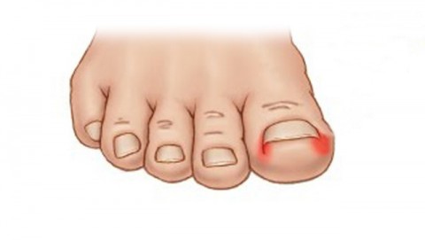 Είσφρυση όνυχος (ονυχοκρύπτωση)