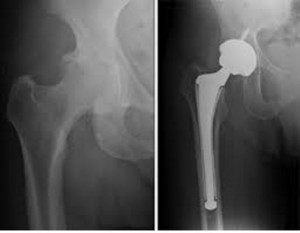 osteoarthritida-gonatos-e-podi-picture-02