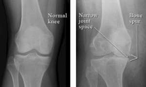 osteoarthritida-gonatos-e-podi-picture-03