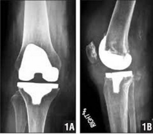osteoarthritida-gonatos-e-podi-picture-04
