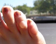 Όχι πια φουσκάλες στα πόδια!