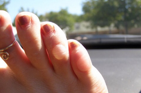 Όχι πια φουσκάλες στα πόδια!