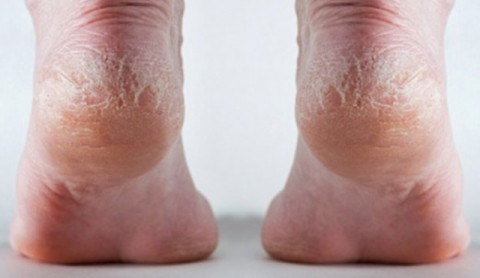 Σκασμένες πτέρνες ή ραγάδες…;