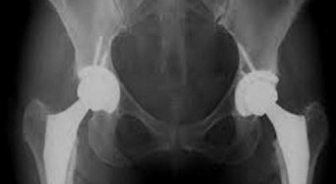 Οστεοαρθρίτιδα ισχίου