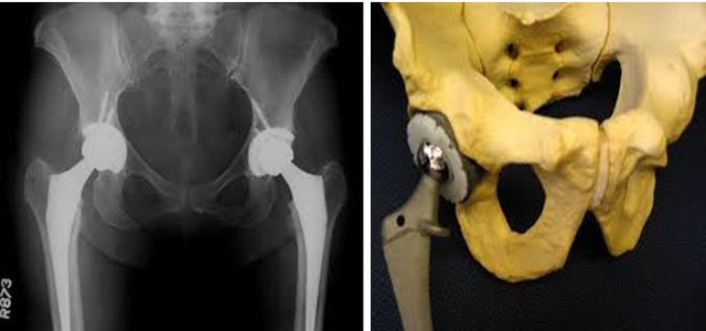 osteathritida-isxiou-e-podi-picture-02