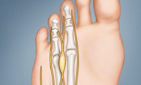 Πόνος στα μικρότερα δάκτυλα