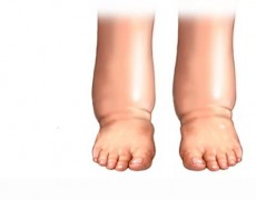 Πρησμένα πόδια