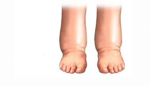 Πρησμένα πόδια