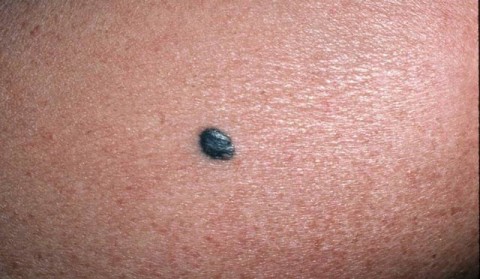 Σπίλος (ελιά) στην πατούσα