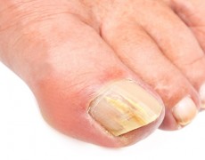 4 τρόποι για να αντιμετωπίσουμε τους μύκητες στα νύχια των ποδιών