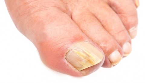 4 τρόποι για να αντιμετωπίσουμε τους μύκητες στα νύχια των ποδιών