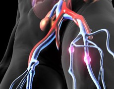 Φλεβική θρόμβωση, τι πρέπει να προσέξετε