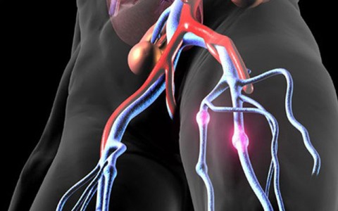 Φλεβική θρόμβωση, τι πρέπει να προσέξετε