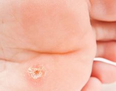 Αντιμετωπίστε εύκολα και αποτελεσματικά τους κάλους στα πόδια σας