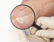 Μύκητες νυχιών (ονυχομυκητίαση) και αντιμετώπιση