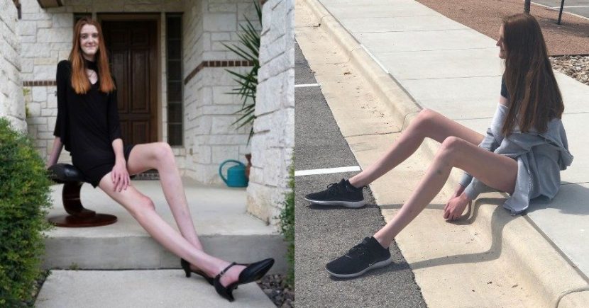 17χρονη με τα πιο μακριά πόδια στον κόσμο εξηγεί πόσο δύσκολη είναι η ζωή της
