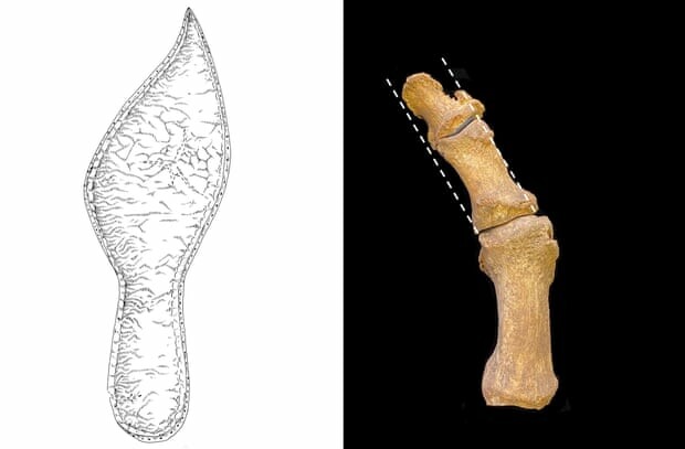 Ανωμαλίες στα οστά που εντοπίστηκαν σε νεκροταφεία του Κέιμπριτζ - Πηγή φωτογραφίας: Cambridge Archaeological Unit/Jenna Dittma
